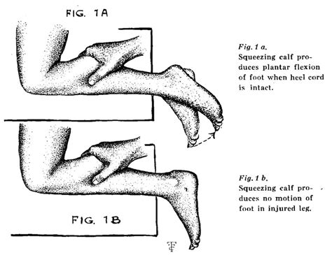 thompson test positive or negative